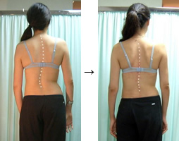 脊柱側弯症と矯正治療
